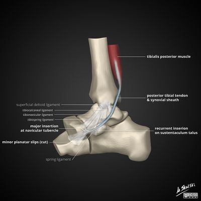 Posterior tibial tendonitis on sale inserts